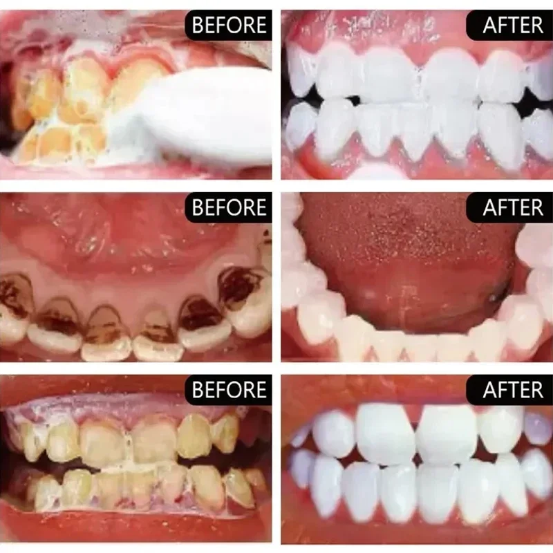 Schnelle Entfernung von Rauchf – Teeth Whitening Fast Bewertung und Preis