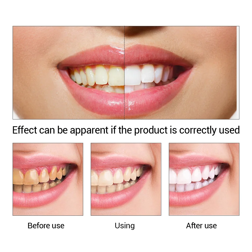 FTEENPLY Zahnaufhellung Essenz – Teeth Whitening Cream Bewertung und Preis