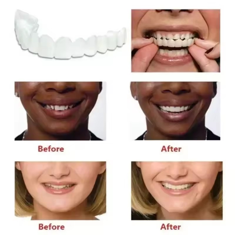 Zahn-Veneers Zahnaufhellung Za – Teeth Whitening Kit Bewertung und Preis