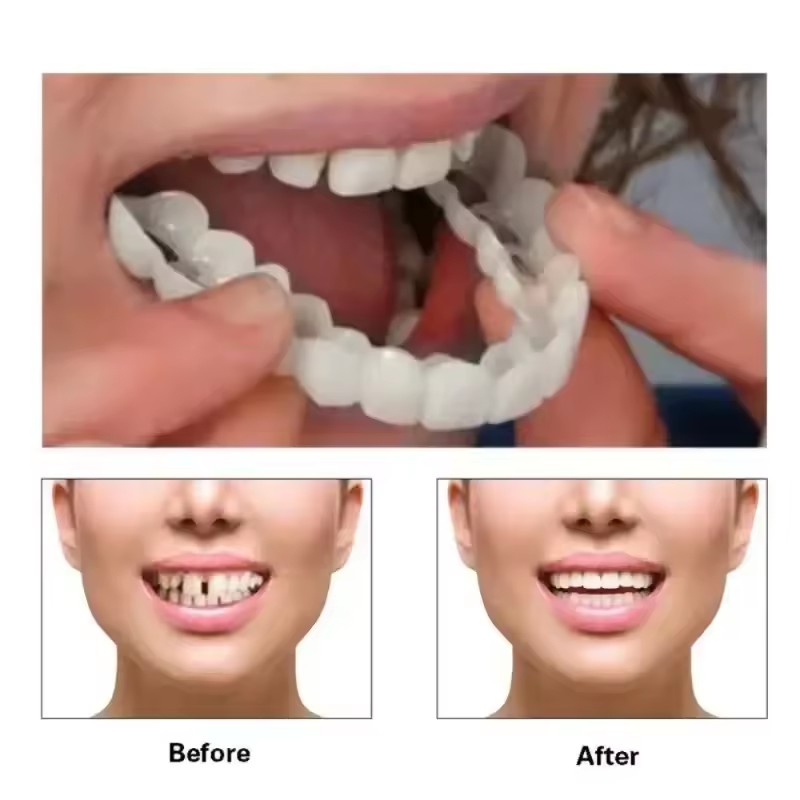 Zahn-Veneers Zahnaufhellung Za – Teeth Whitening Kit Bewertung und Preis